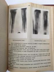 Hematogene Had Osteomyeliteler ve Bugünkü Tedavi Methode'ları