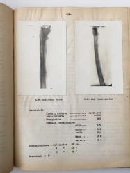 Hematogene Had Osteomyeliteler ve Bugünkü Tedavi Methode'ları